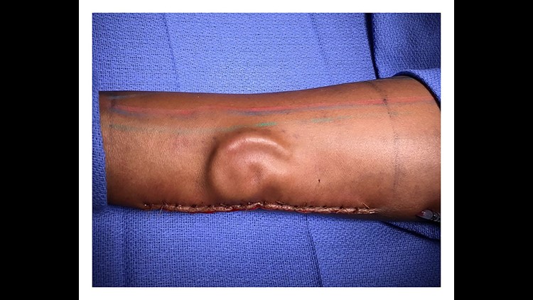 Doctors Grow Ear on Woman's Forearm