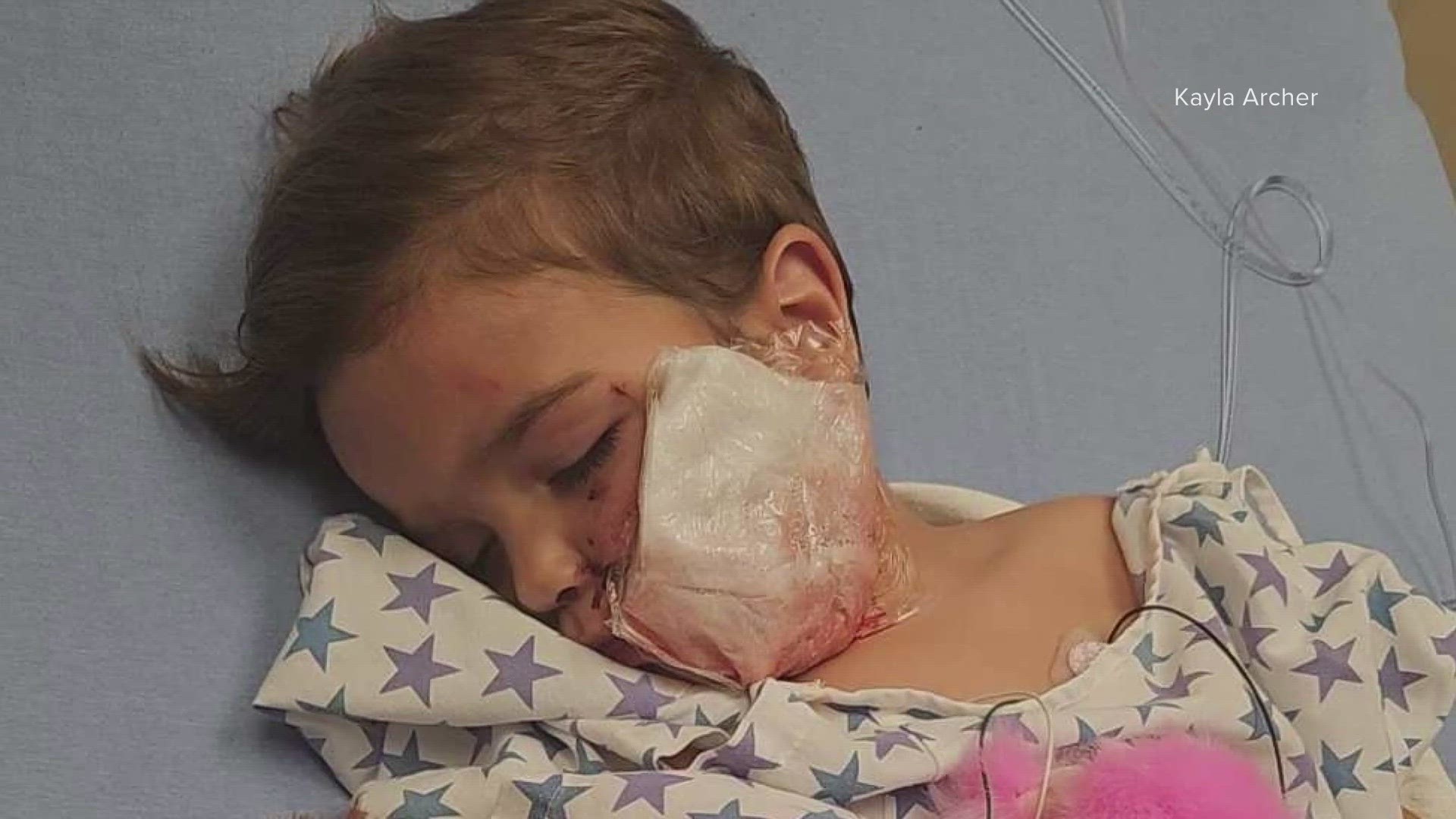 A two-year-old boy underwent surgery for extensive facial injuries after being attacked by a Pitbull.