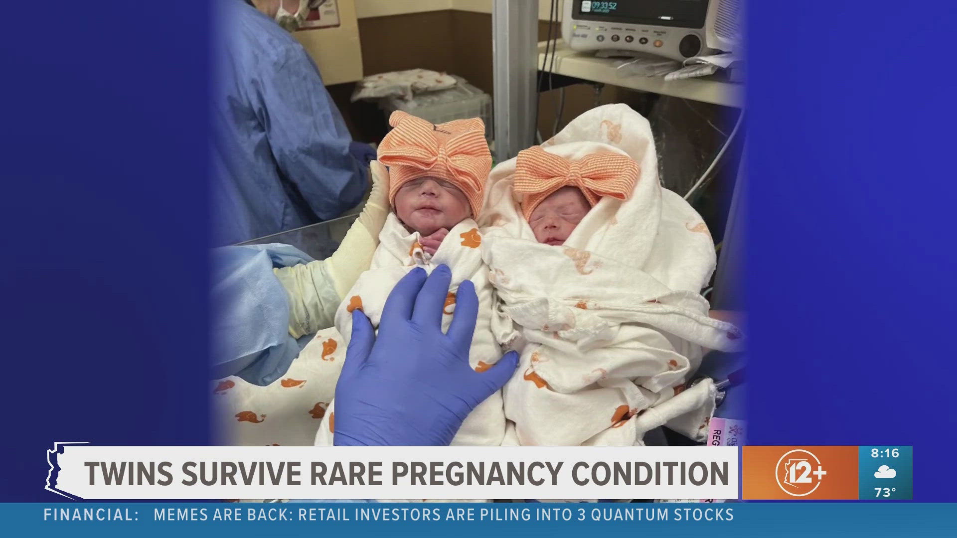 East Valley twins survive rare condition, inutero surgery
