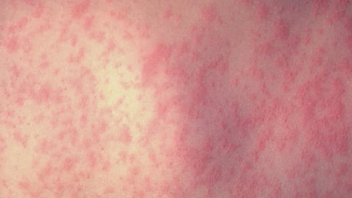 2 new cases of measles confirmed in Arizona