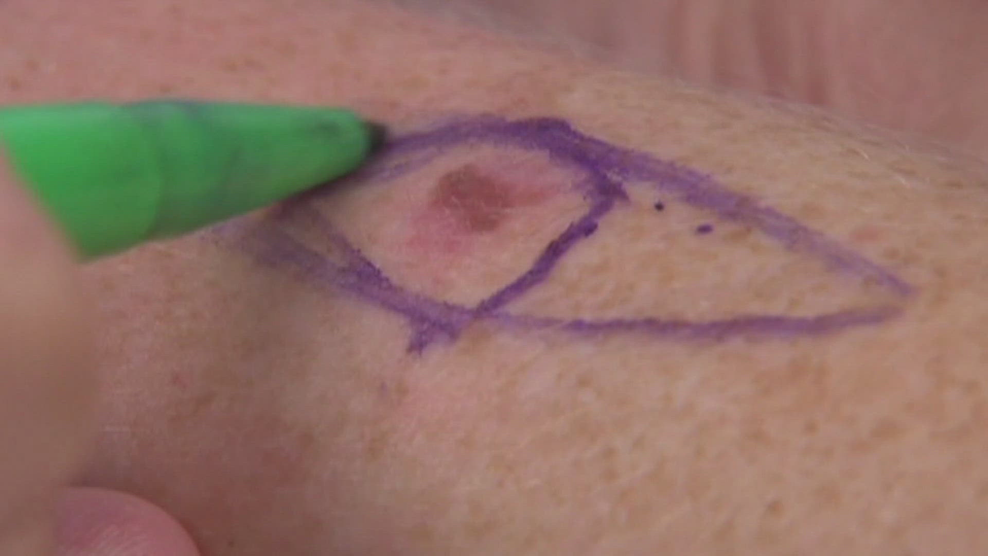 The HonorHealth Research Institute has initiated an international clinical trial in Arizona, aiming to test new cell therapy for melanoma treatment.