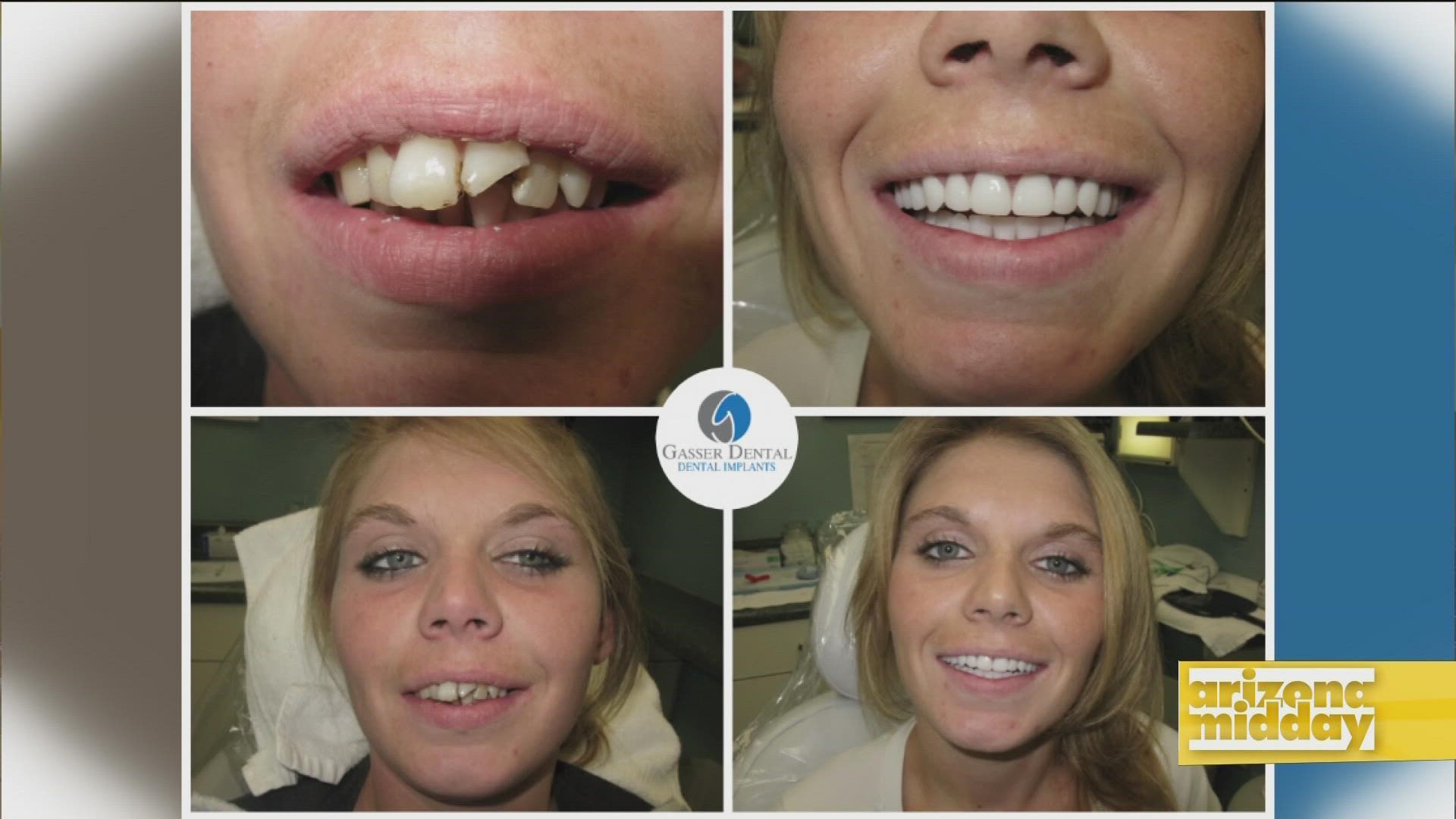 Dr. Gasser shares how he can change a smile overnight with advanced dental technology.