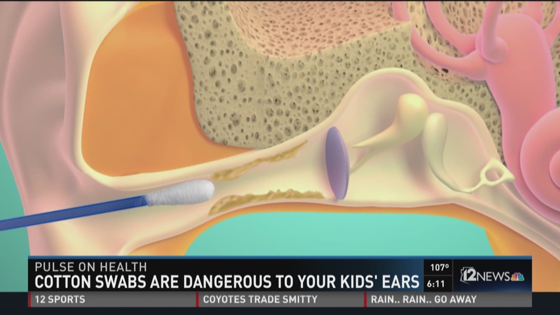 Cotton swabs are dangerous to your kid's ears