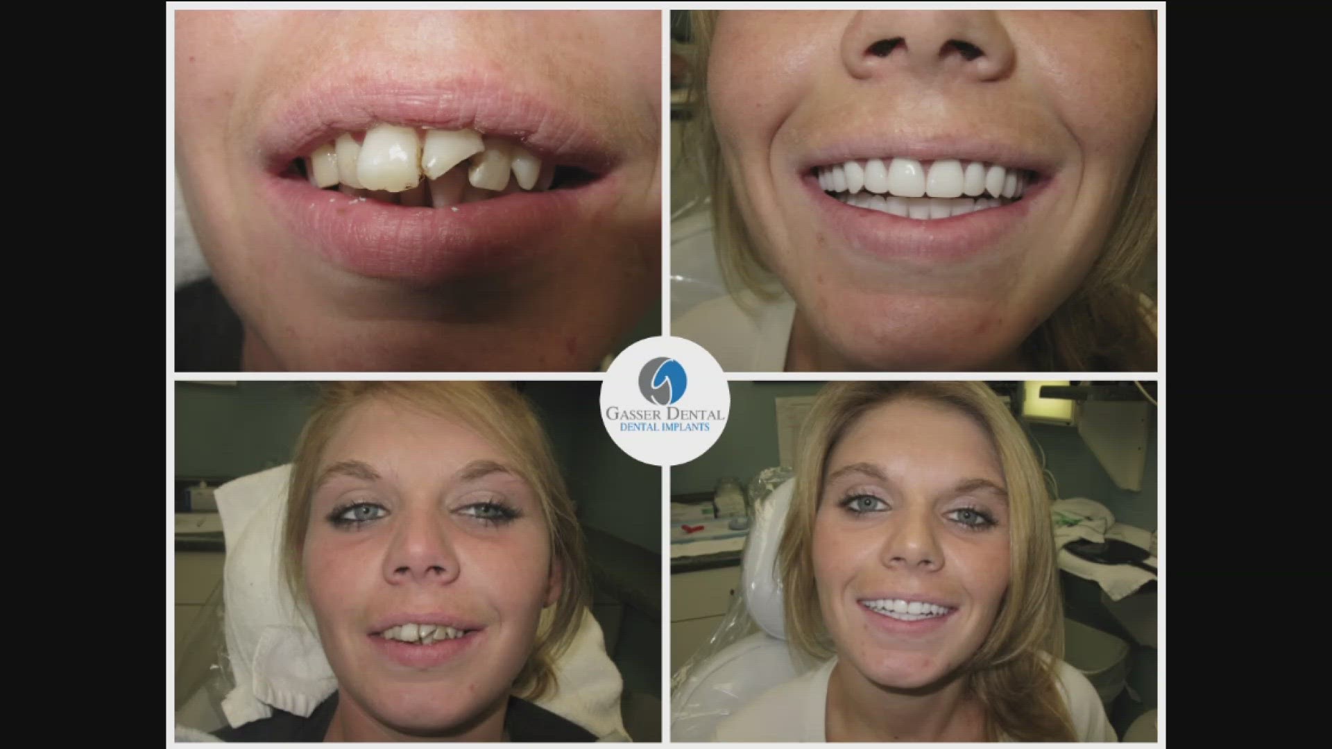 Robin Kill shares how a smile transformation from Dr Kevin Gasser of Gasser Dental has given her a confidence boost.