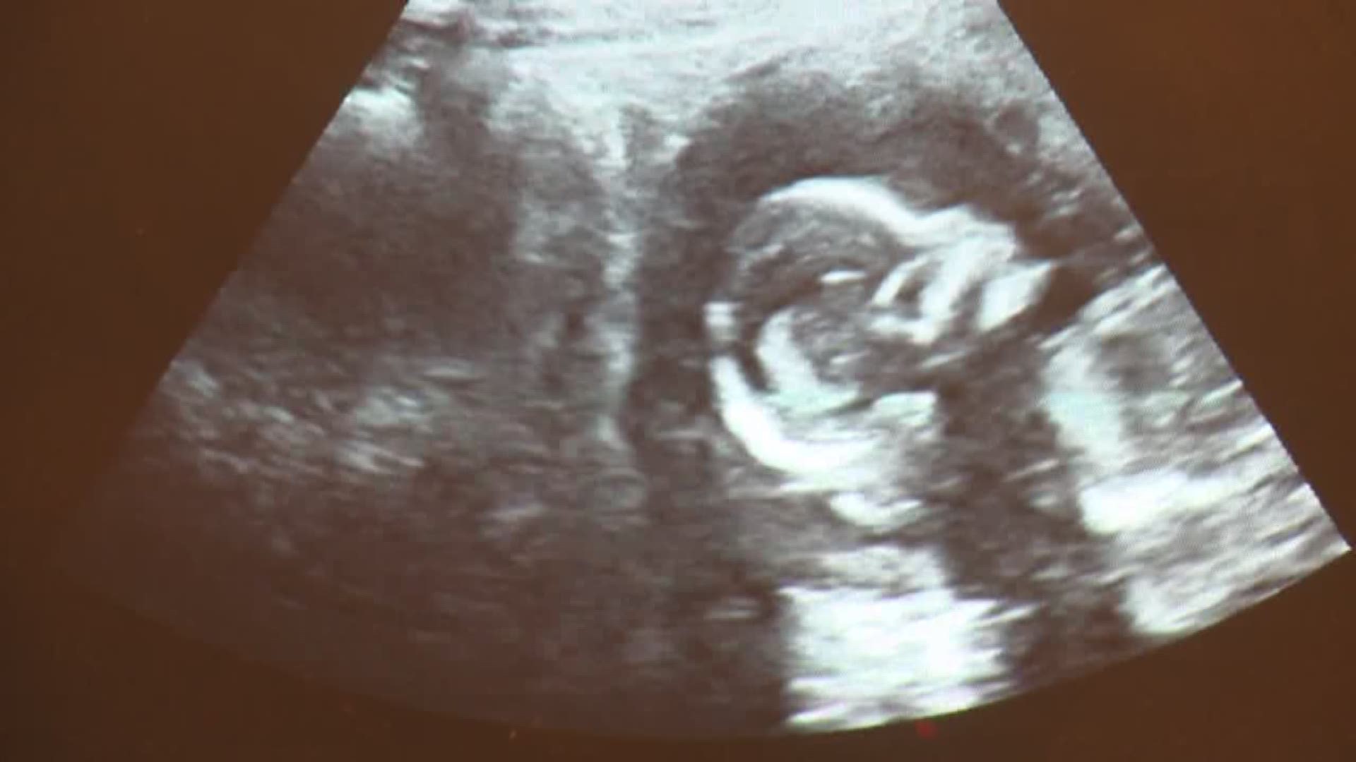 abortion babies at 12 weeks