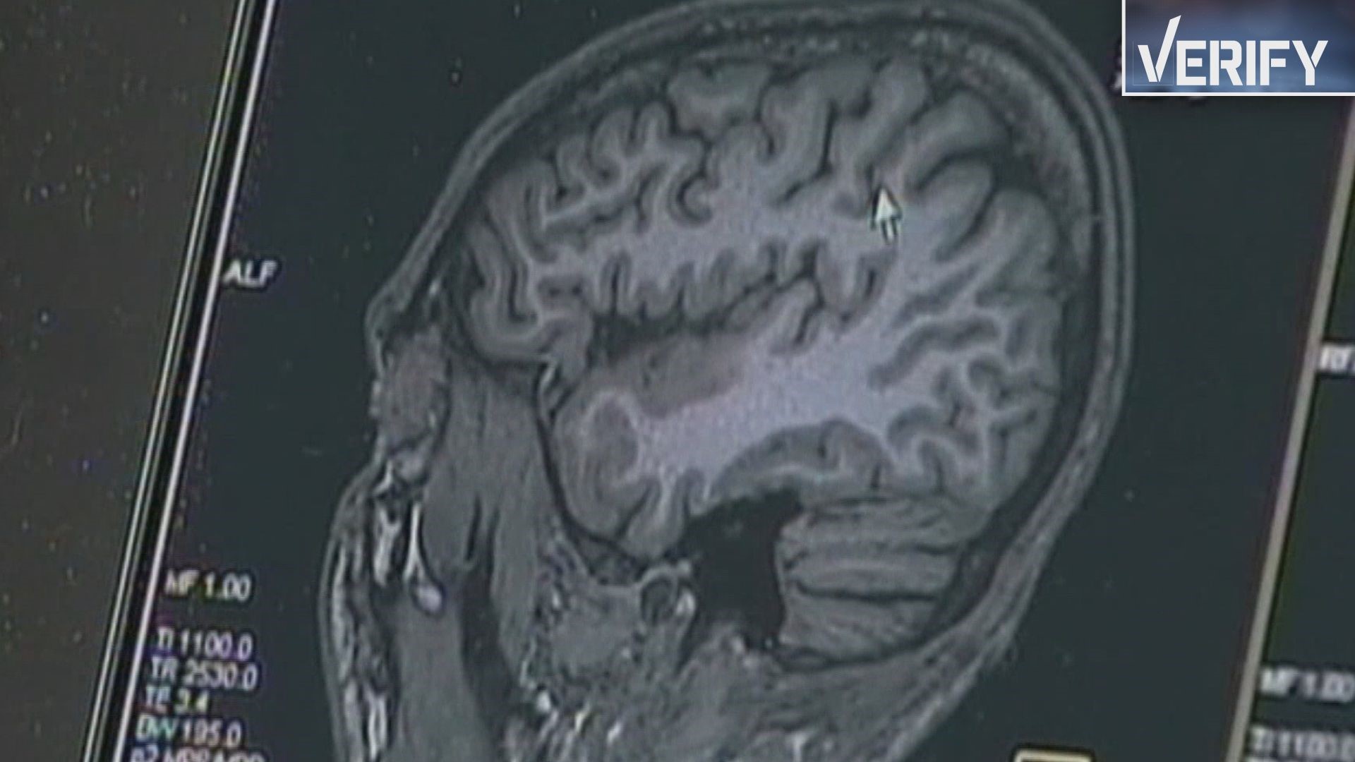 Having migraines after the storms? Expert explains why; how to prevent them