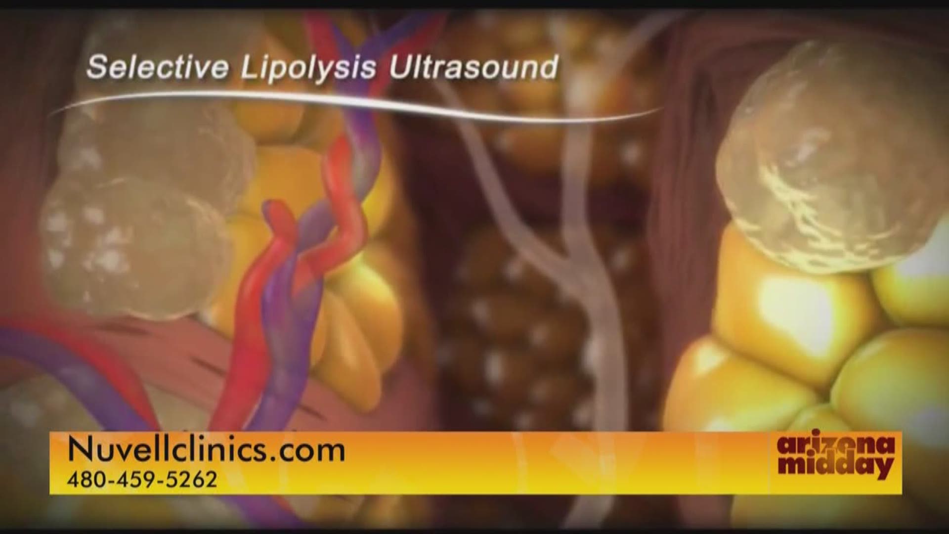 Lunchtime Lipo with Nuvell's VShape Ultra