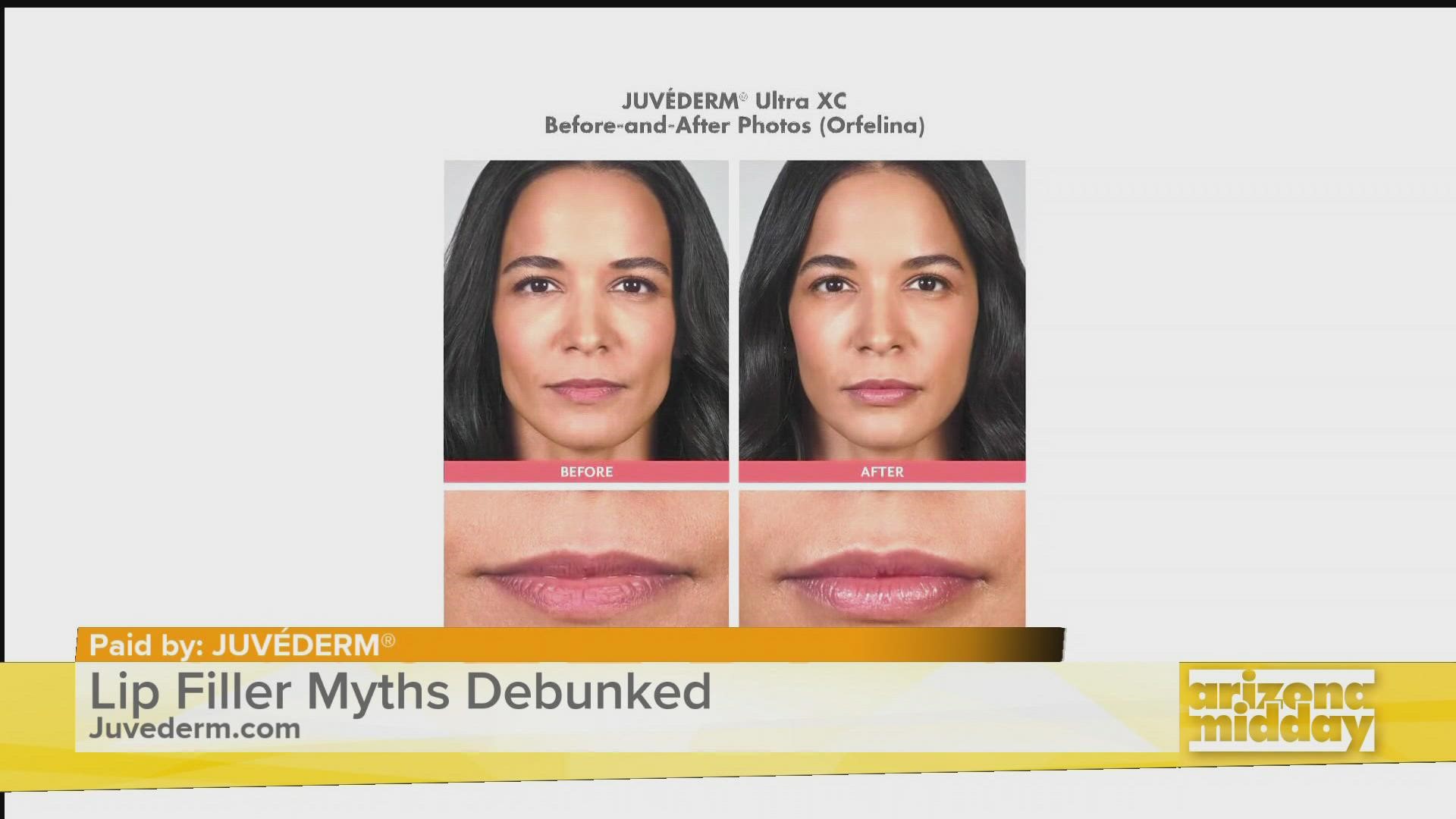 Dr. Sherly Soleiman, Board-Certified Physician, shares the top myths associated with lip filler & why she chooses JUVÉDERM®