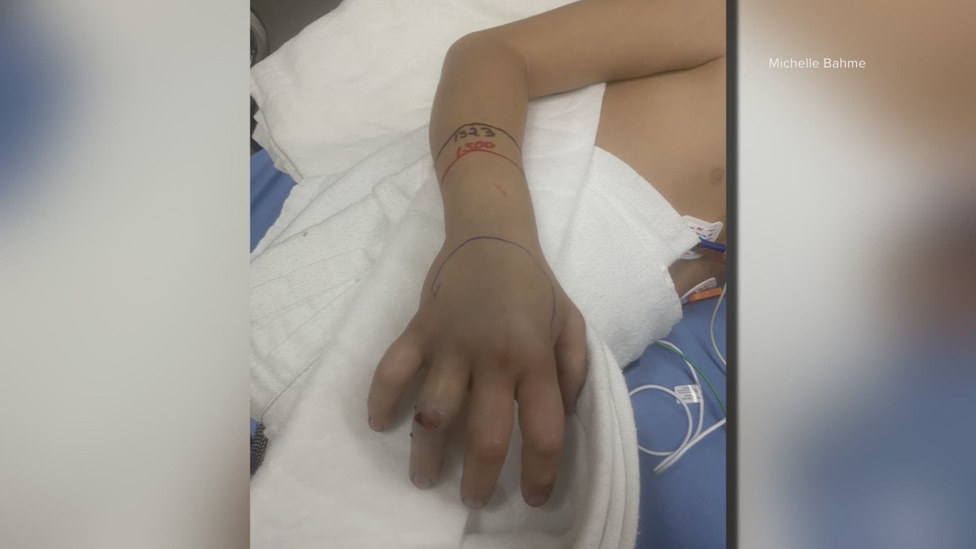 The boy was bitten by a rattlesnake while camping in Yavapai County on Sunday.