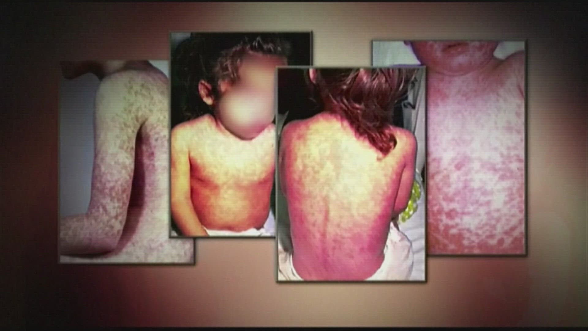 A visitor to Maricopa County from overseas has tested positive for measles and that news has health officials concerned as measles can be highly contagious.