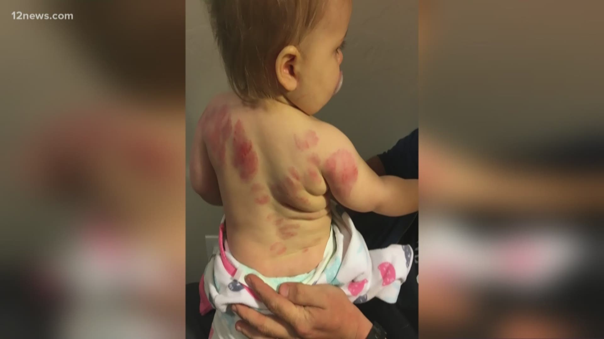 Two families are on alert after their toddlers came home with multiple bite marks in separate incidents at different Arizona day cares.
