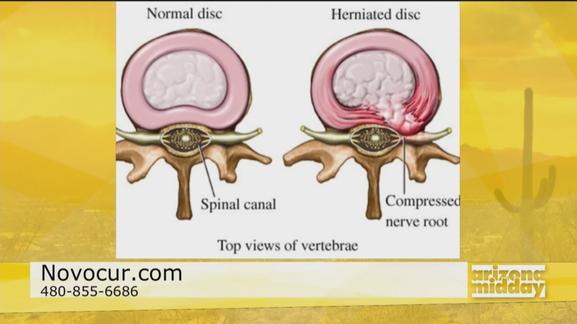 Dr. Alex Bigham of Novocur Pain Management Clinics talks about several treatment options that will relieve herniated disc pain.