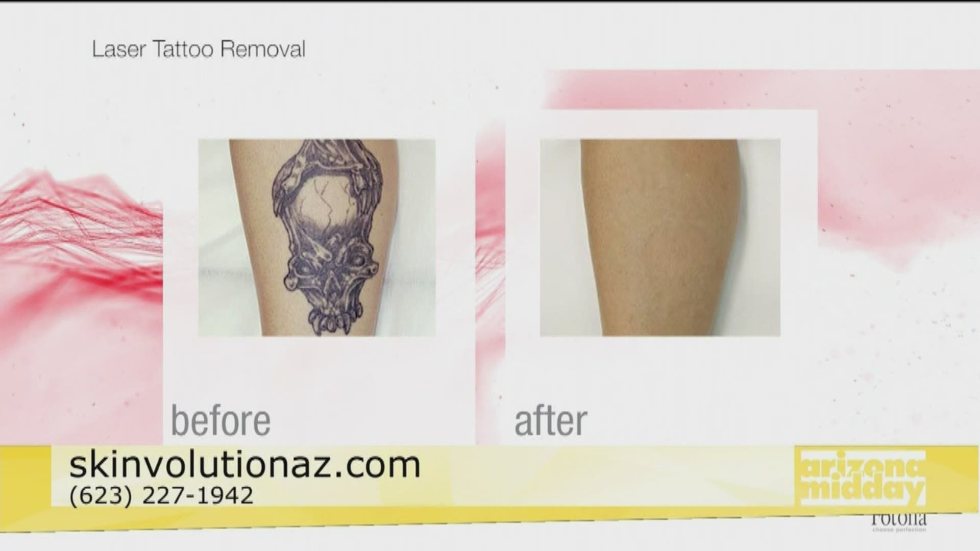 Dr. Trupti K Patel tells us about tattoo removal with Skinvolution.