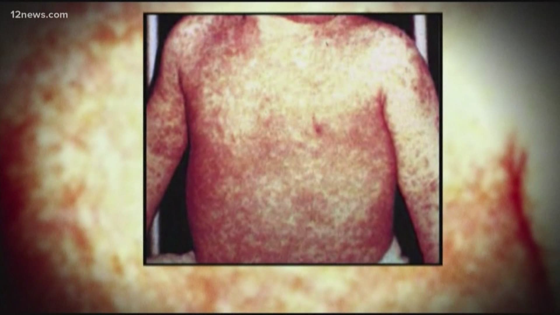 Public health officials are concerned about a potential outbreak of measles in Arizona. The number of immunized people in Arizona has dropped below 95%, the number needed to maintain "herd immunity". There aren't enough people vaccinated to keep an outbreak from happening, officials say.