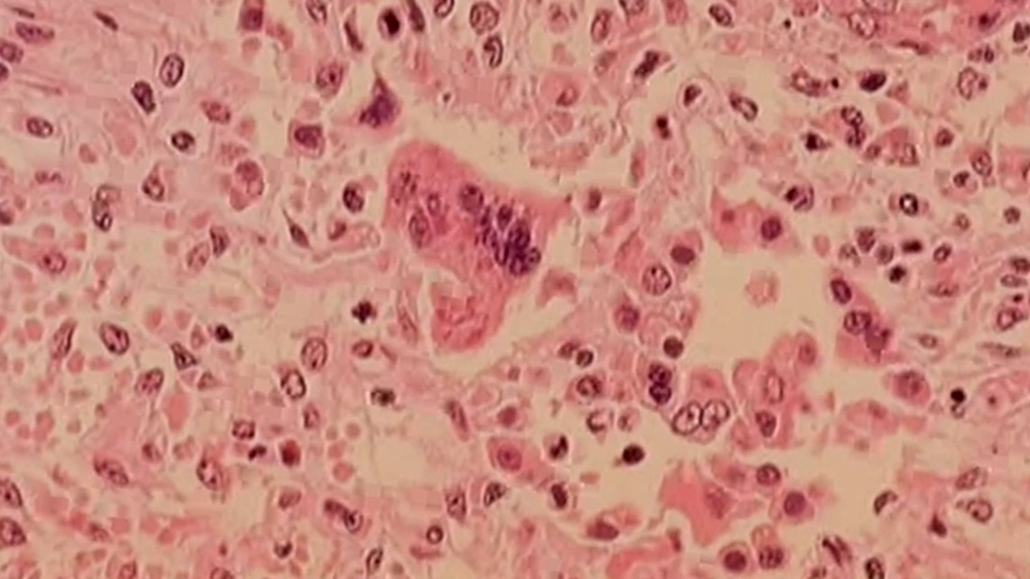 Possible measles exposure at 5 East Valley locations - Vimarsana News