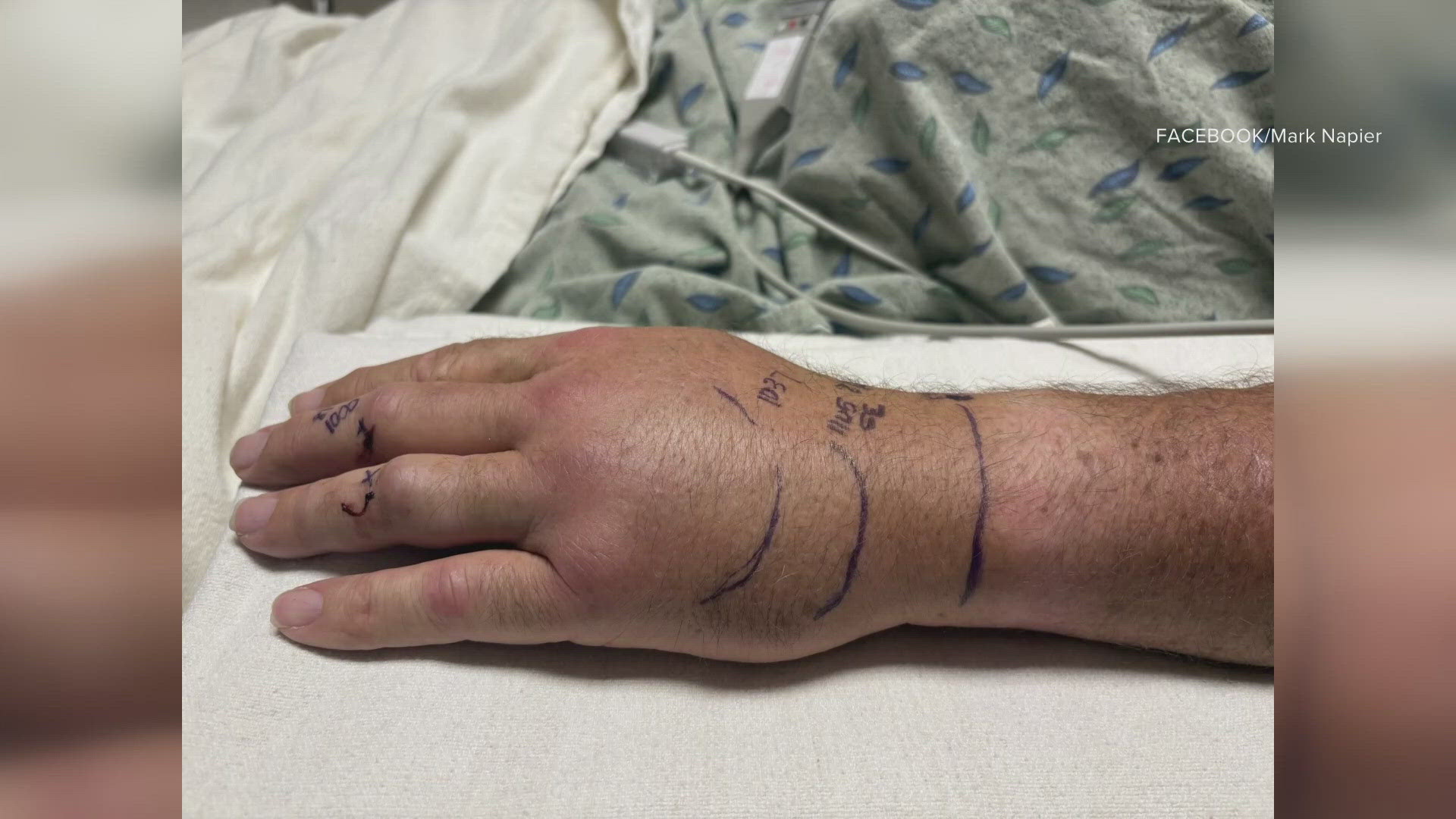 Former Pinal County Sheriff Mark Napier shared photos of his bite from the hospital while seeking treatment.
