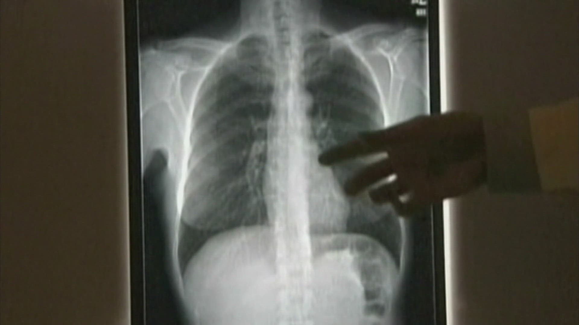 It's Lung Cancer Awareness Month and we're taking a look at the increased cases in lung cancer in women.
