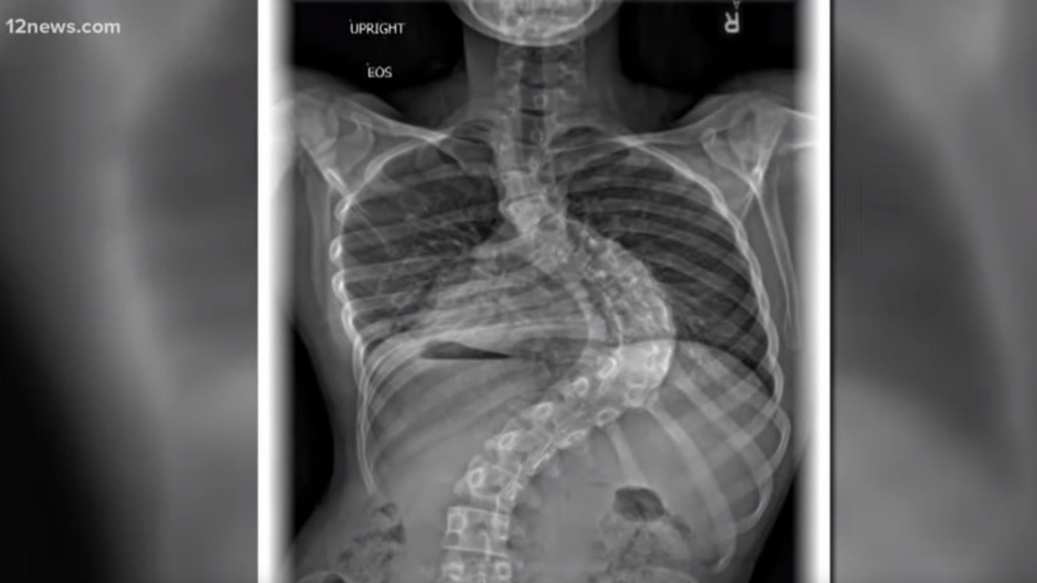 Severe Scoliosis