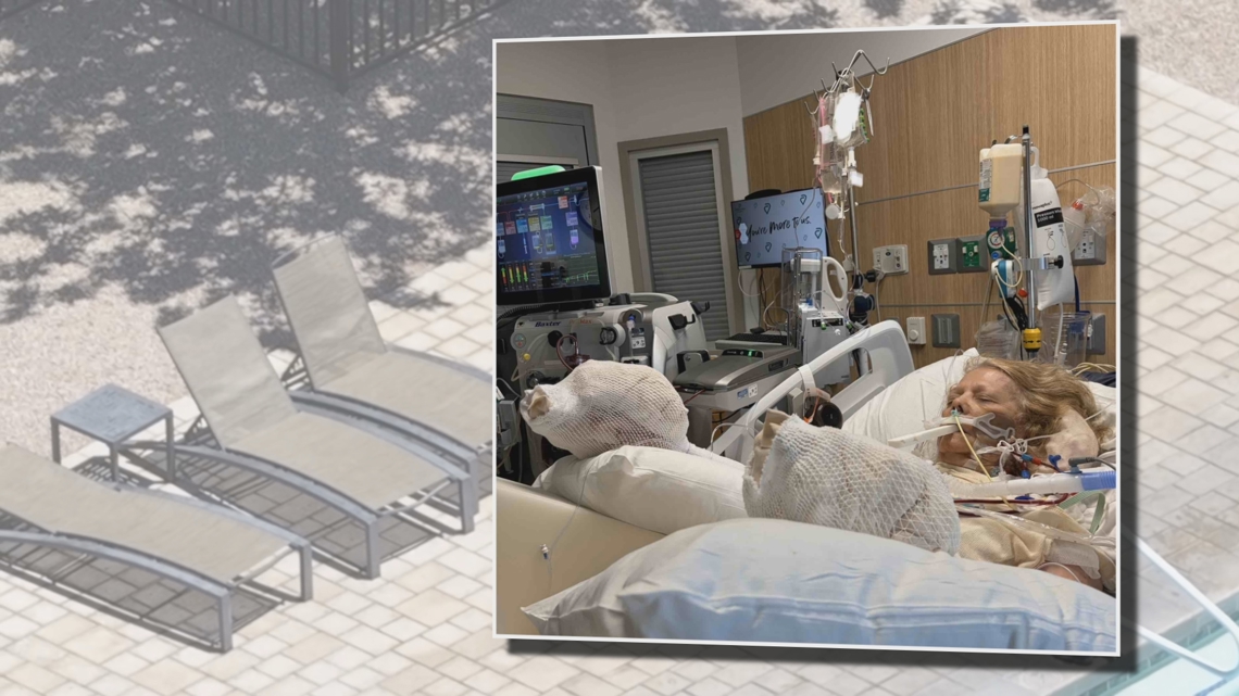 Arizona woman suffers heat stroke, third-degree burns after falling asleep by pool