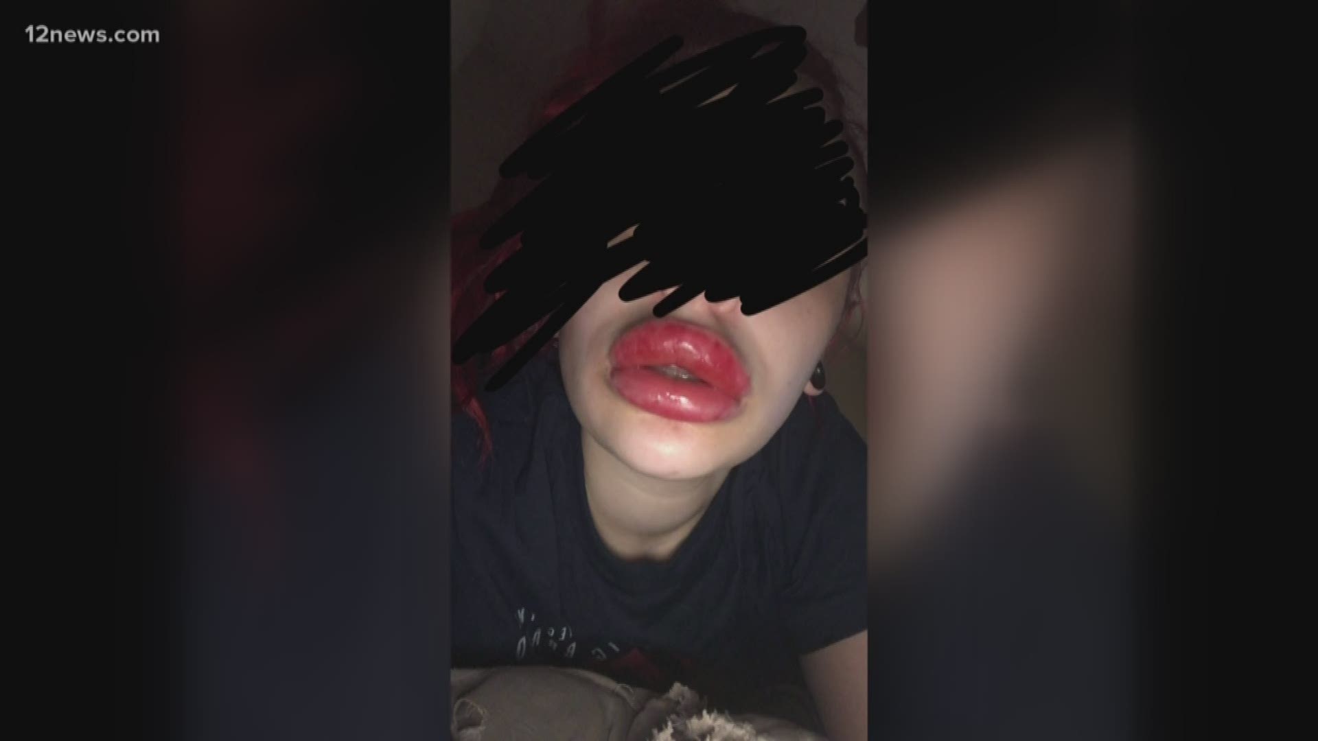 Warning: Images in this story may be disturbing for some viewers. Police in Maricopa are investigating a woman accused of injecting lip fillers into several women who then suffered catastrophic injuries. Those women believe they were injected with a tainted lip filler and now the woman who ran the business out of her Maricopa home is nowhere to be found.