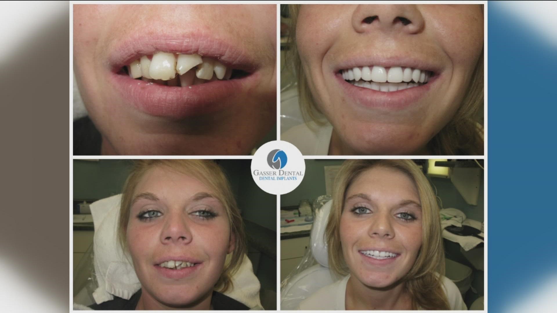 Dental Implant  : Transform Your Smile with Confidence