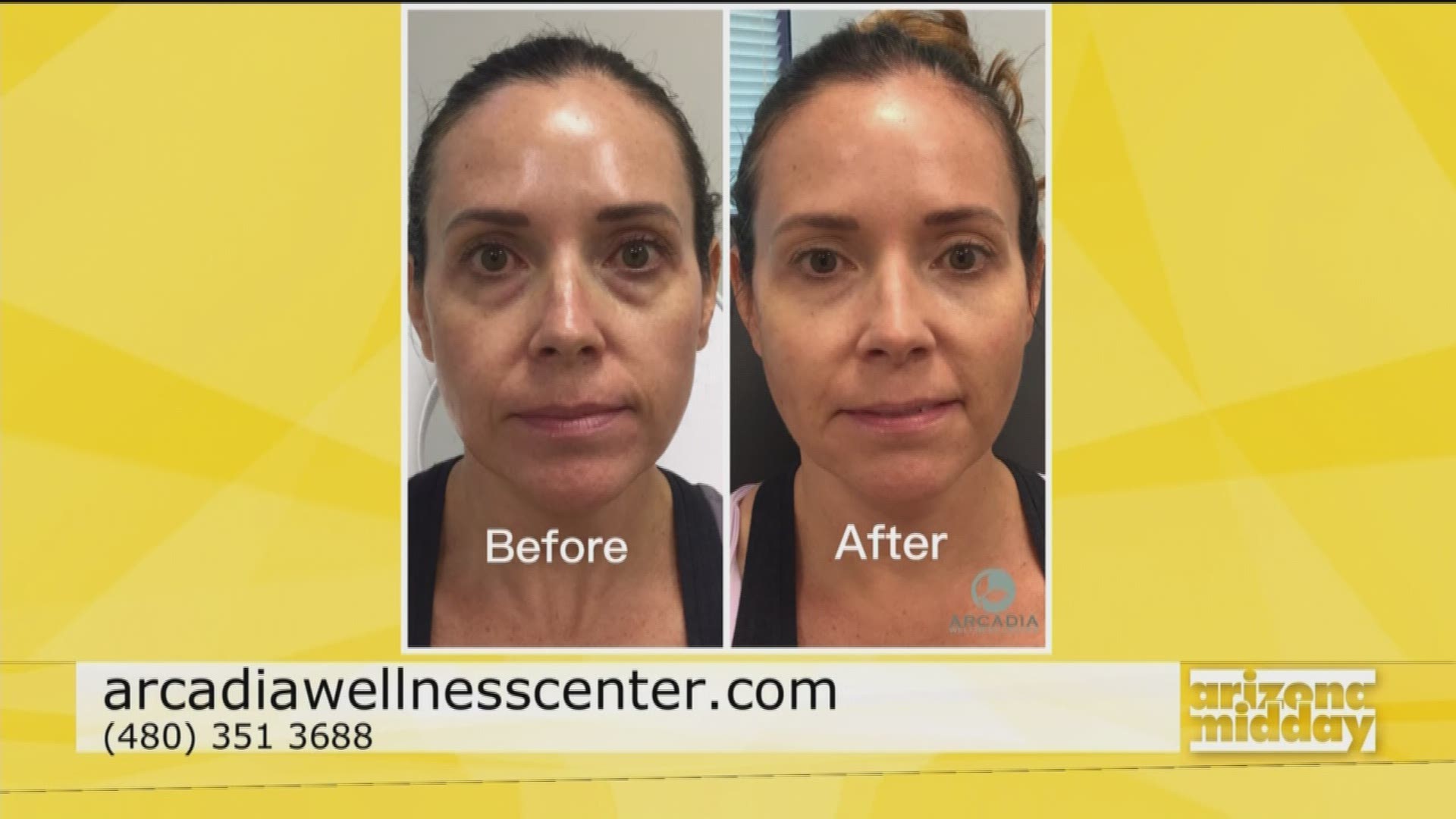 Nobody likes under eye bags and cellulite! Arcadia Wellness Center can help you treat these trouble areas and Holly Mueller is here to tell us how.