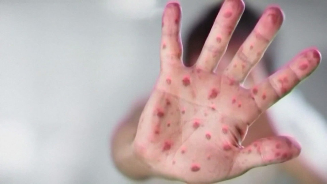 3 new measles cases confirmed in county, 10 exposure sites identified in Mesa