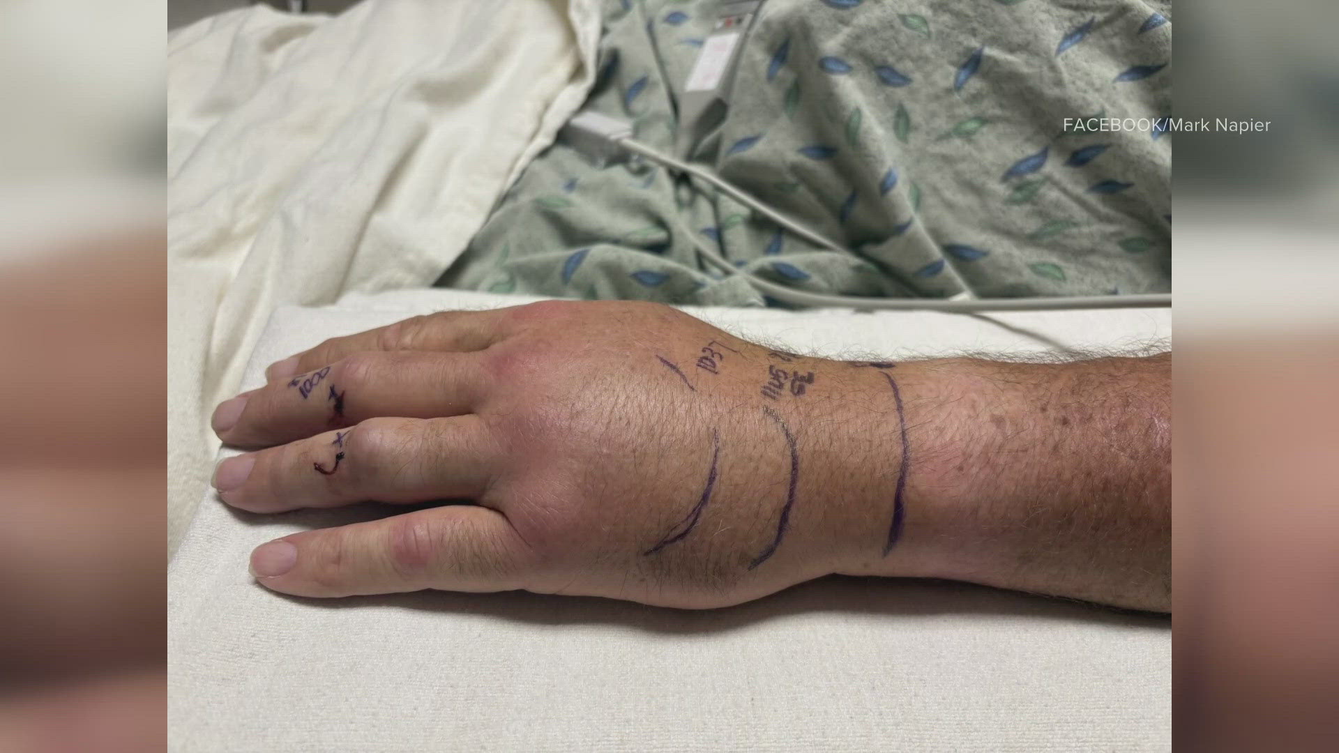 The former sheriff of Pima County is advising Arizona residents to be extra aware of their surroundings after he recently sustained a rattlesnake bite to his hand.