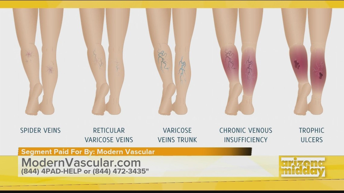 Help For Your Legs with Modern Vascular | 12news.com