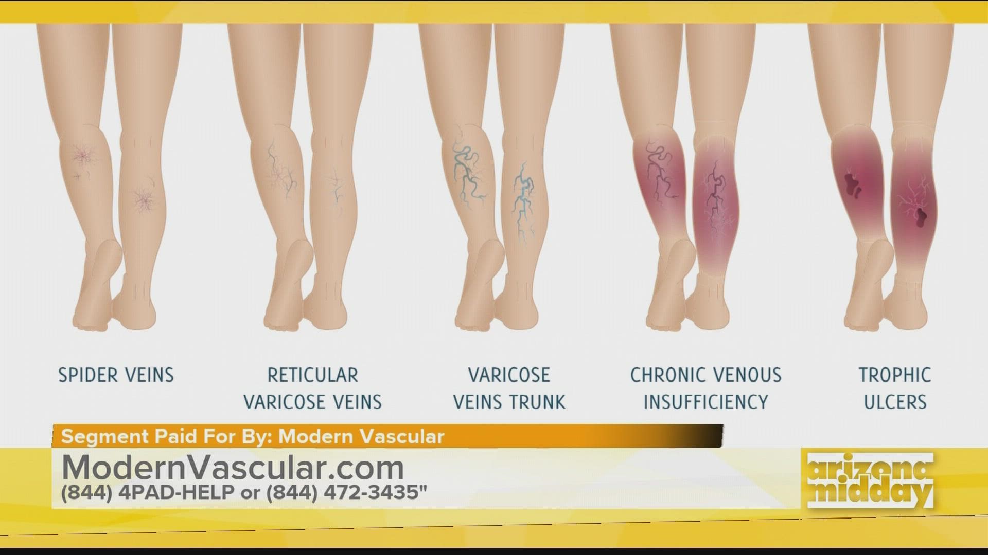 Dr. Scott Brannan with Modern Vascular talks to us about Venous Insufficiency and the treatments to treat the condition - giving you relief.