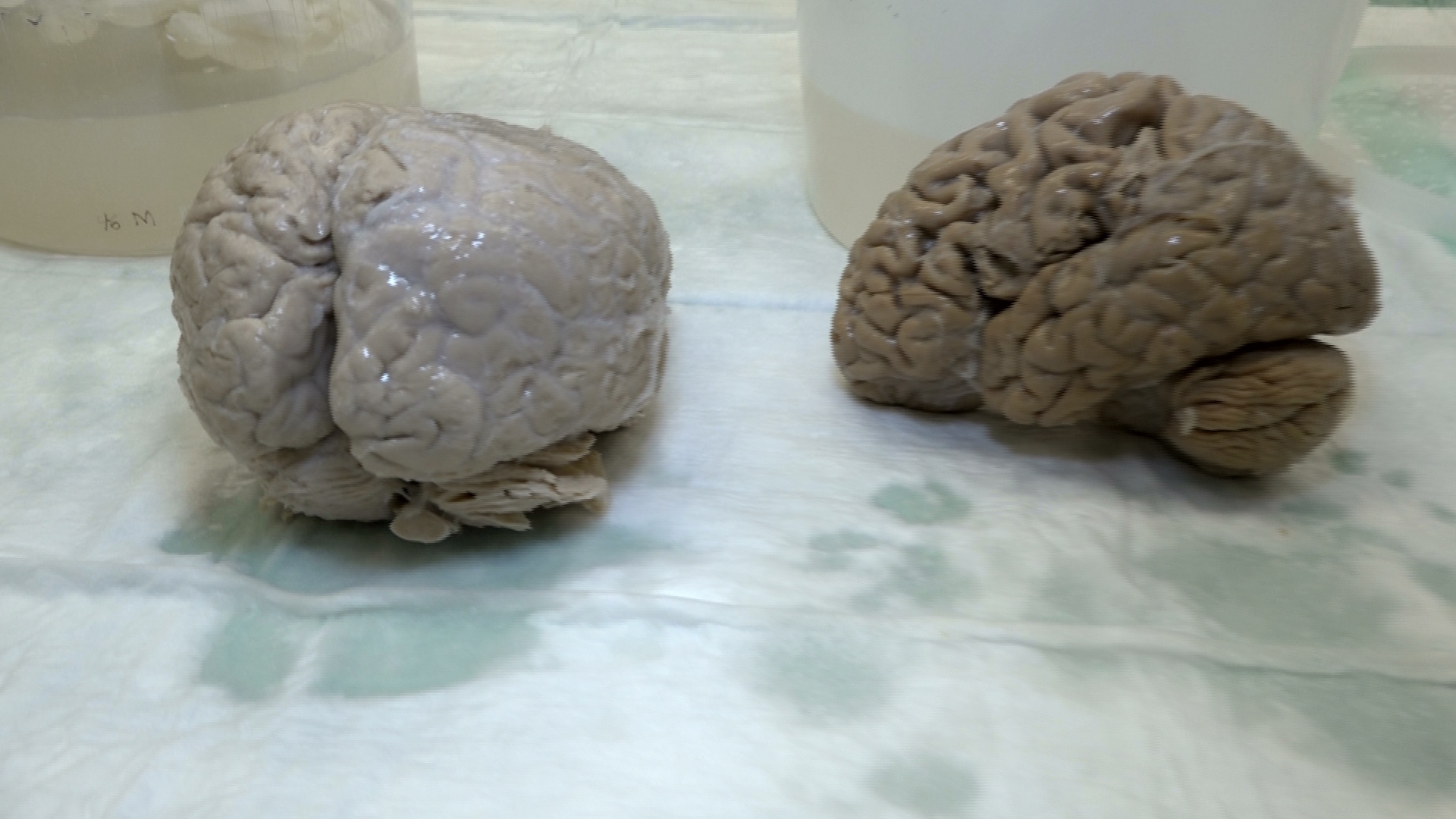 Cerebros en el laboratorio de investigaciones de Alzheimer de Sun Health en Banner, uno esta normal y el más oscuro y pequeño fue afectado por demencia.