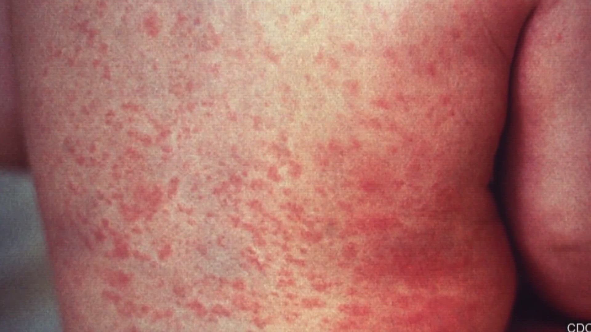 An international visitor confirmed to have measles was at two locations in the Valley, health officials said.