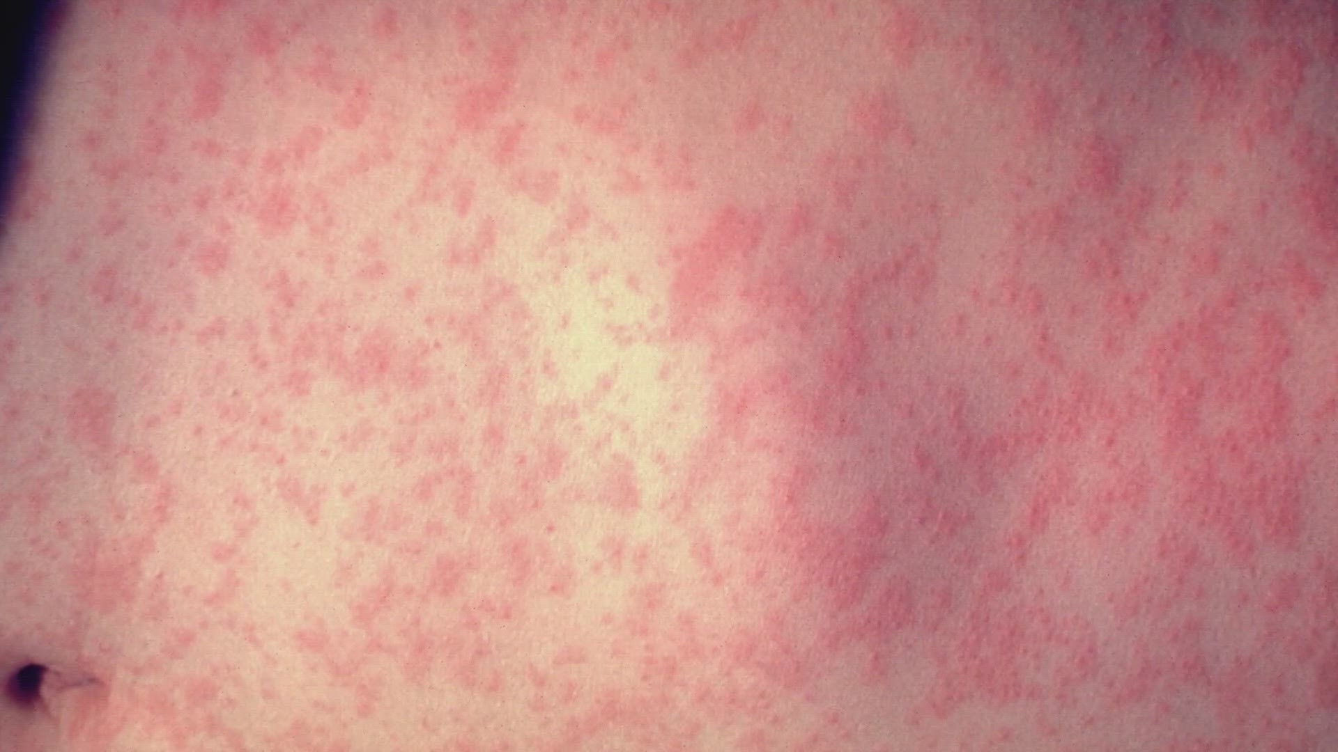 If cases continue to rise, measles could lose its 'elimination' status.